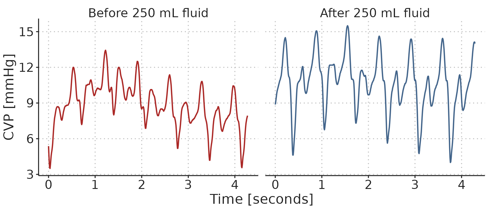 A sample of the CVP waveform recorded before and after administration of 250 ml fluid.